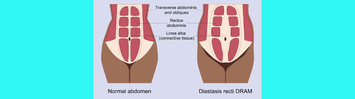 Postnatal Abdominal Muscle Separation